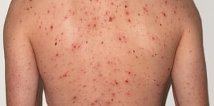 New NHS jab aims to cut chickenpox cases across Cornwall