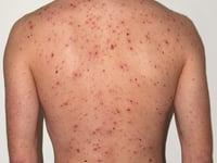 New NHS jab aims to cut chickenpox cases across Cornwall