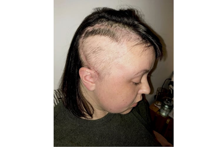 After the tumour was removed, Leah had radiotherapy and chemotherapy. (Picture: Leah Jensen/SWNS)